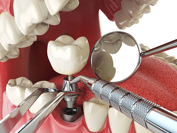 Best Emergency Wisdom Teeth Removal in Lochearn, MD